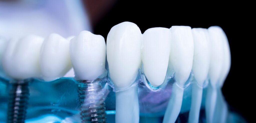 Clinică de implant dentar